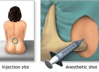 Epidural Anestezisinin Yan Etkileri Nelerdir?